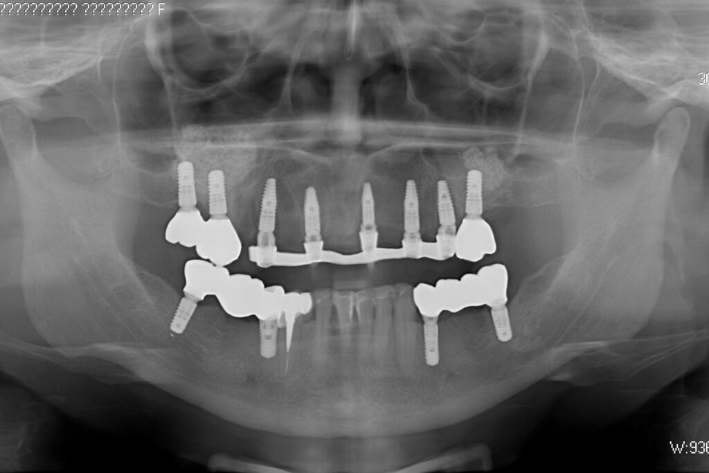 результат имплантации