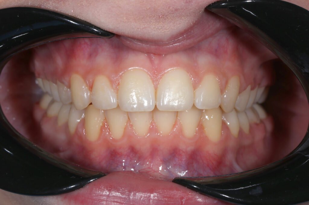 результат лечения брекет-системой