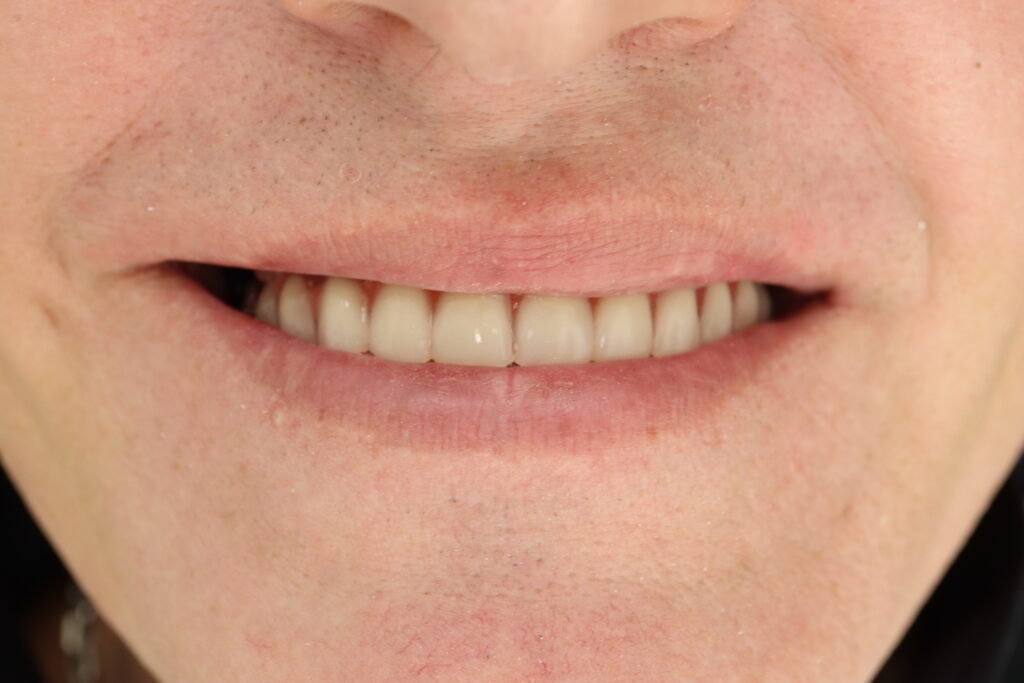 результат протезирования