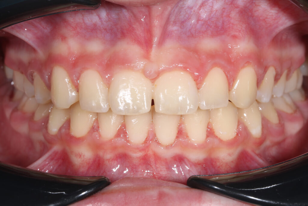 Ортодонтическое лечение брекетами