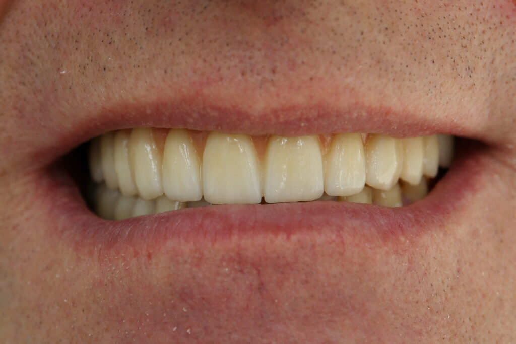 Протезирование на имплантатах Megagen Anyone