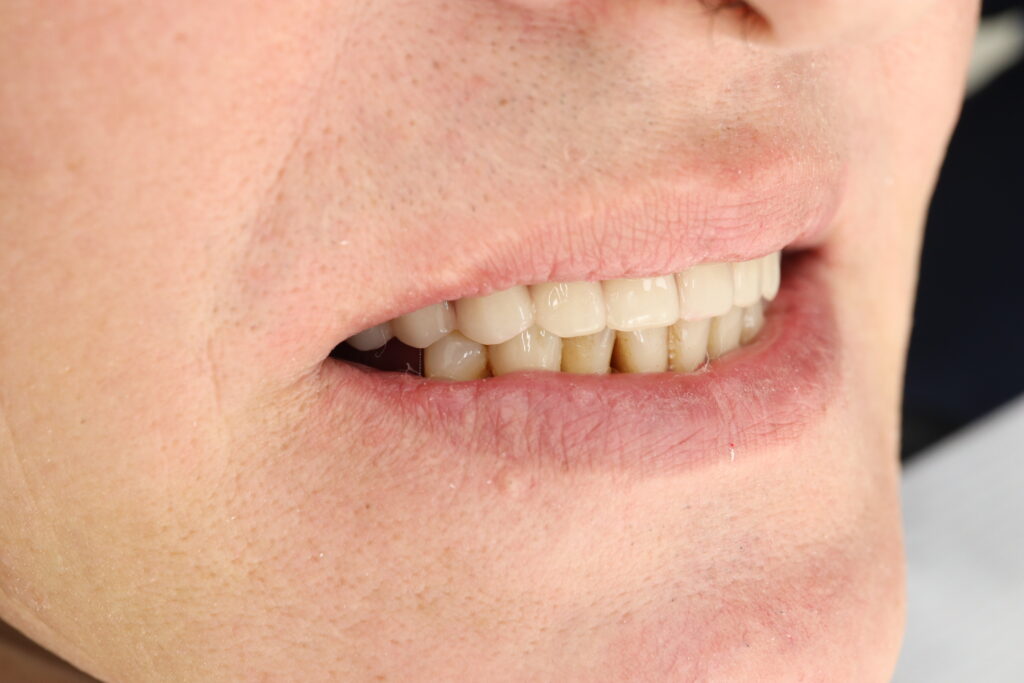 результат протезирования