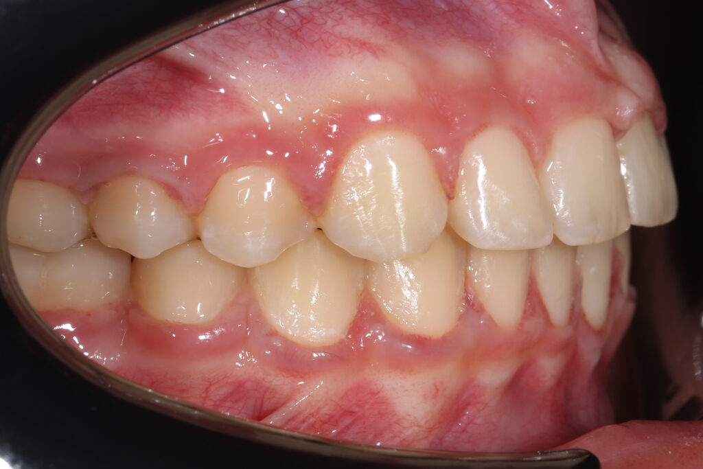 результат ортодонтического лечения