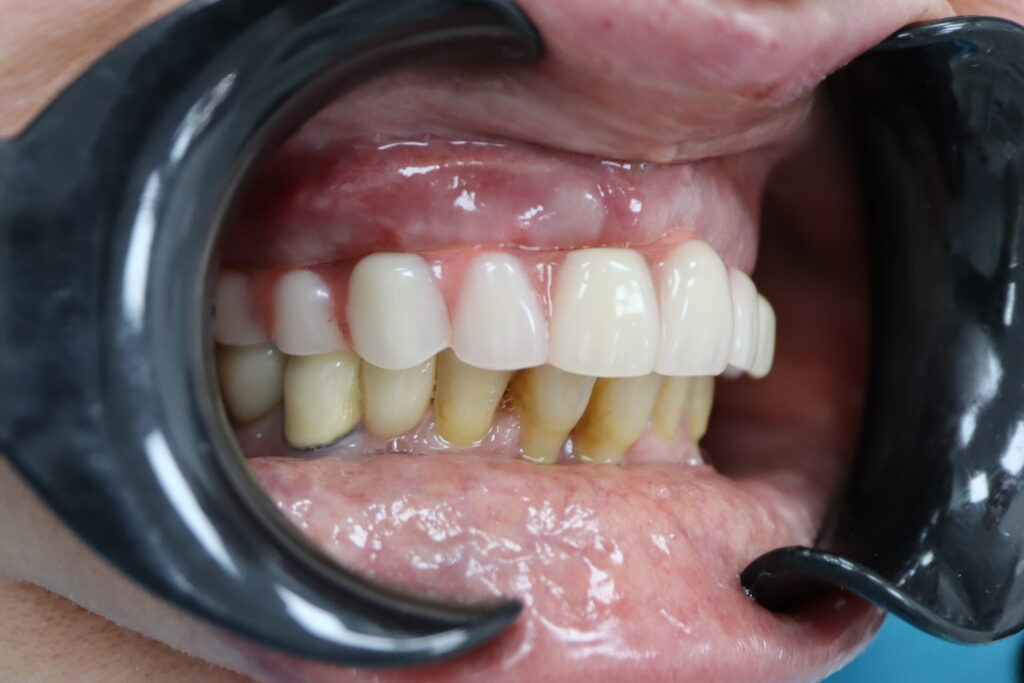 результат имплантации