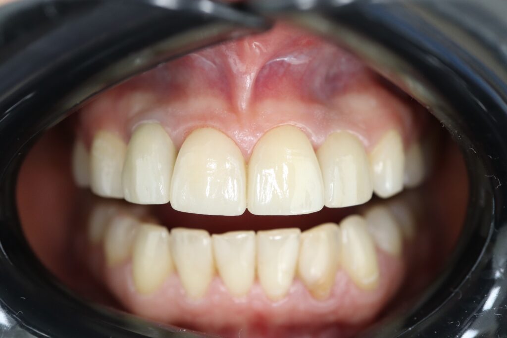 Комбинированное протезирование коронками на имплантатах