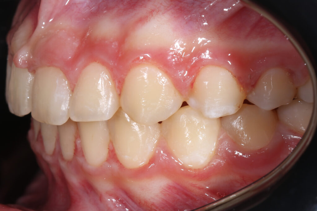 результат ортодонтического лечения