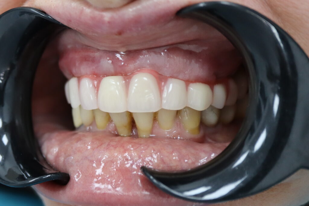 результат имплантации