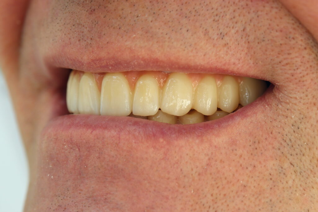 результат имплантации Megagen Anyone