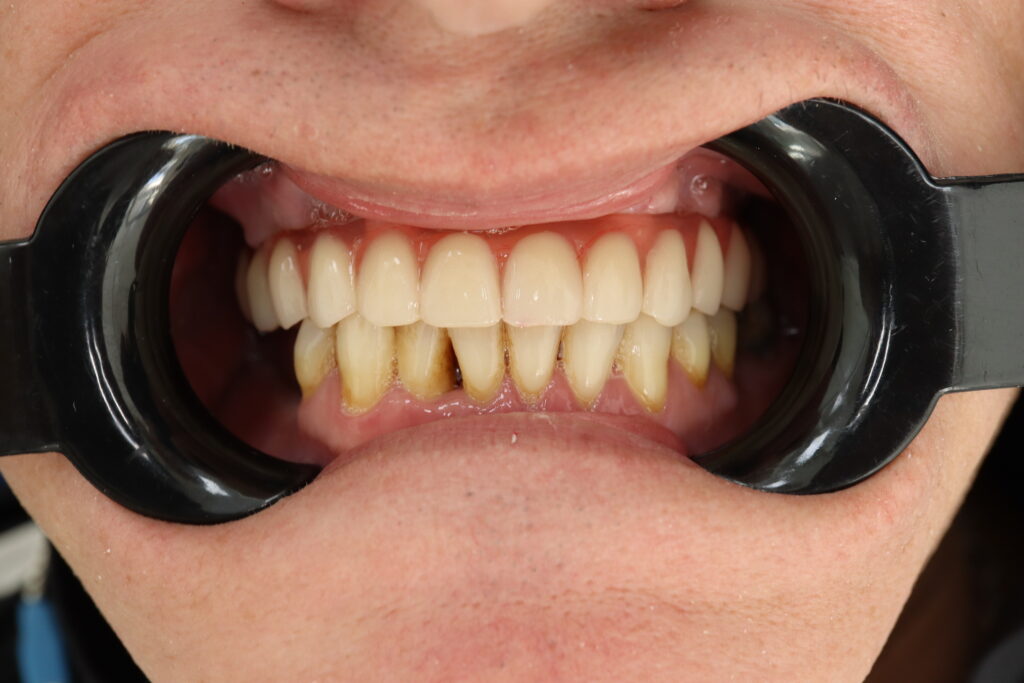 результат протезирования