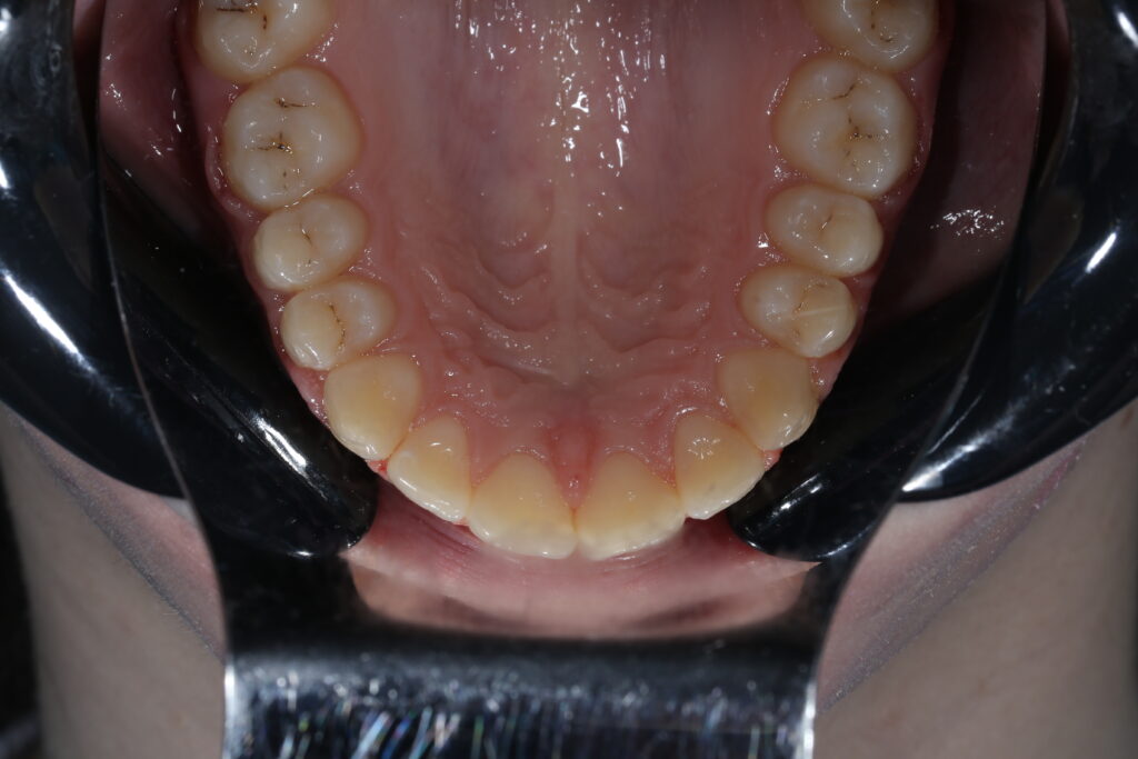 результат лечения брекет-системой