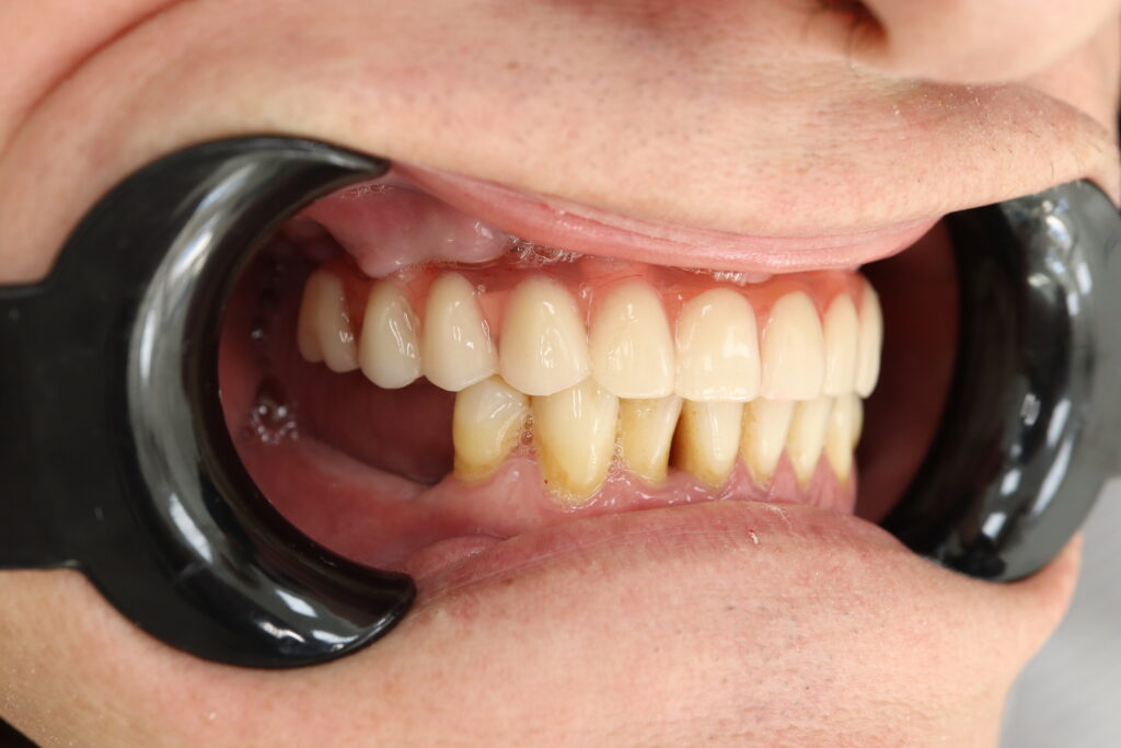 результат протезирования