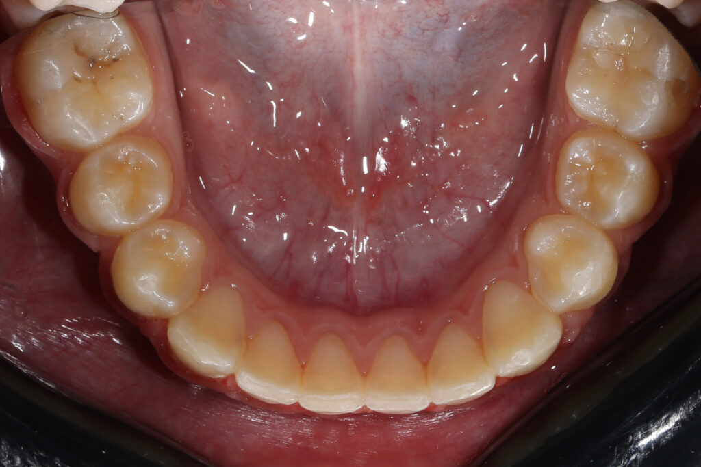 результат ортодонтического лечения