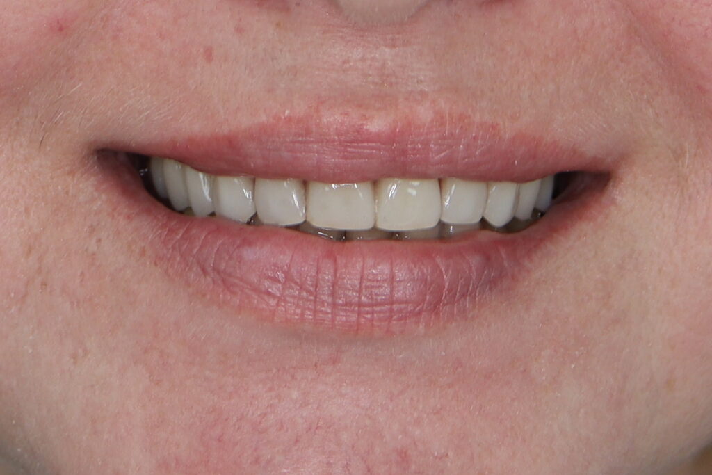 результат тотальной имплантации