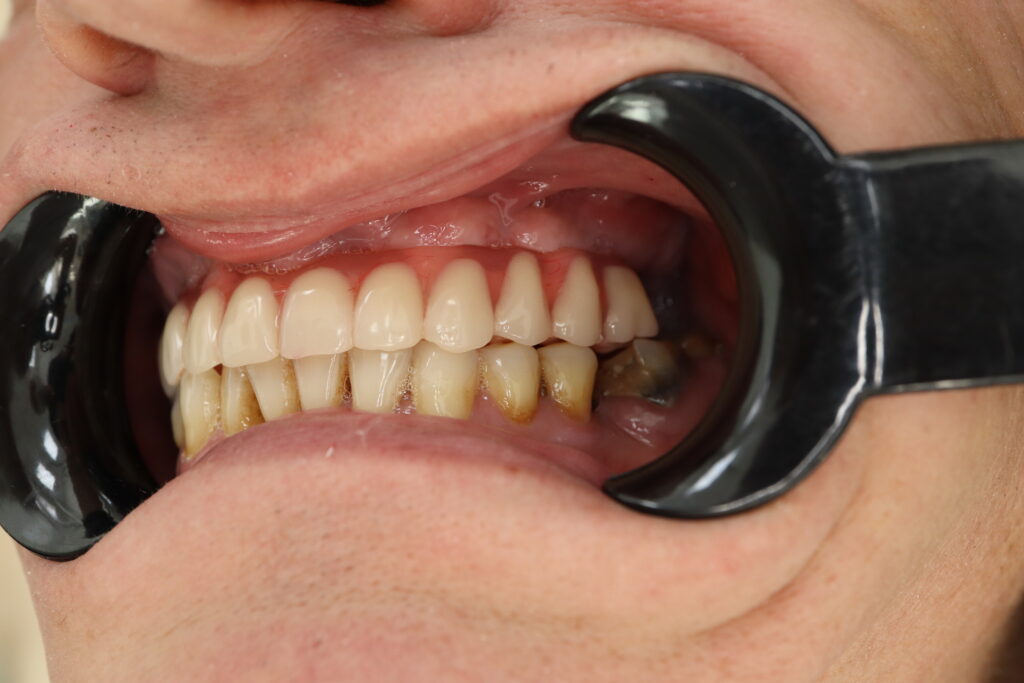 результат протезирования