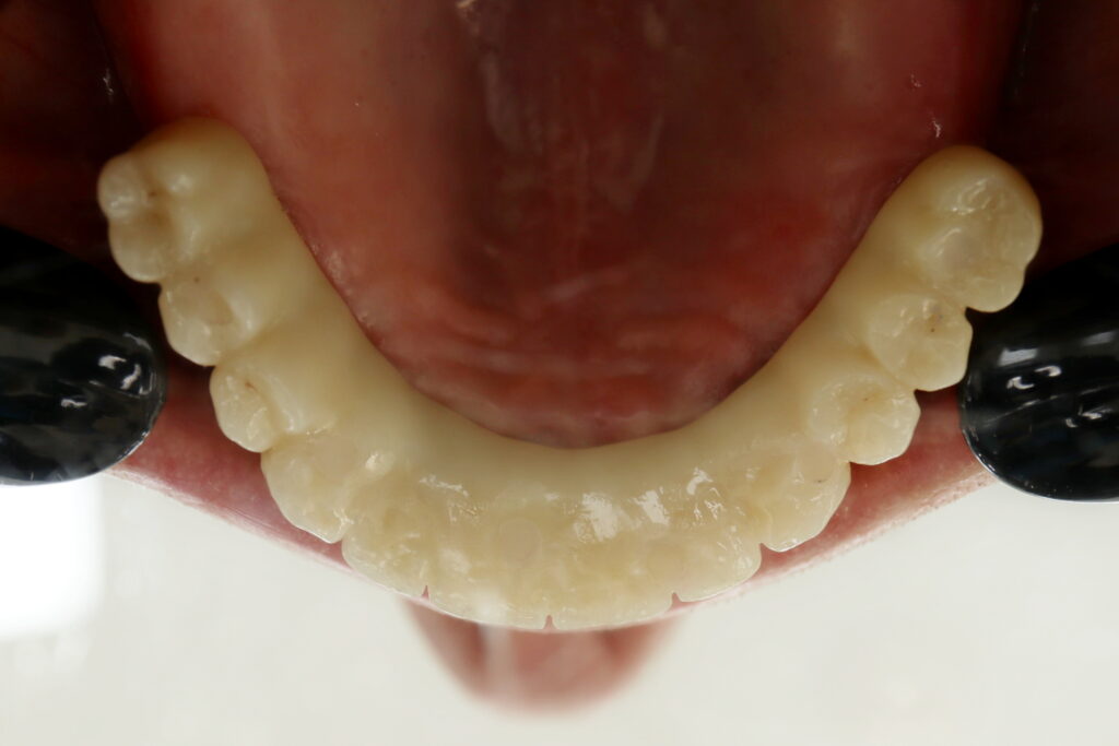 результат имплантации Megagen Anyone