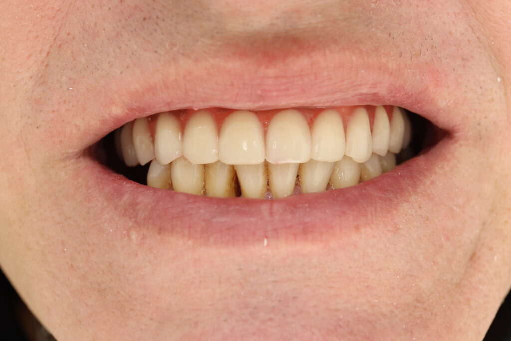 результат протезирования