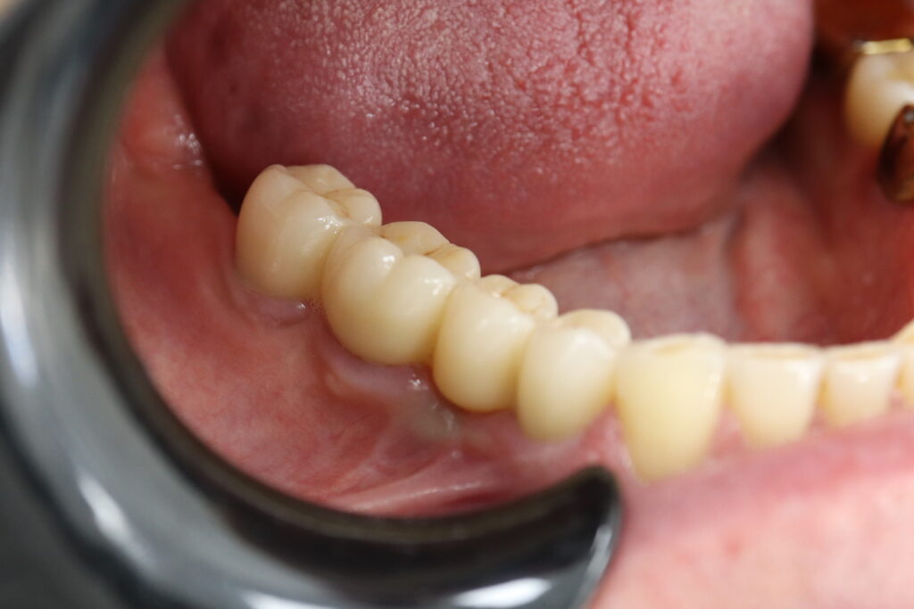 результат имплантации Megagen Anyone