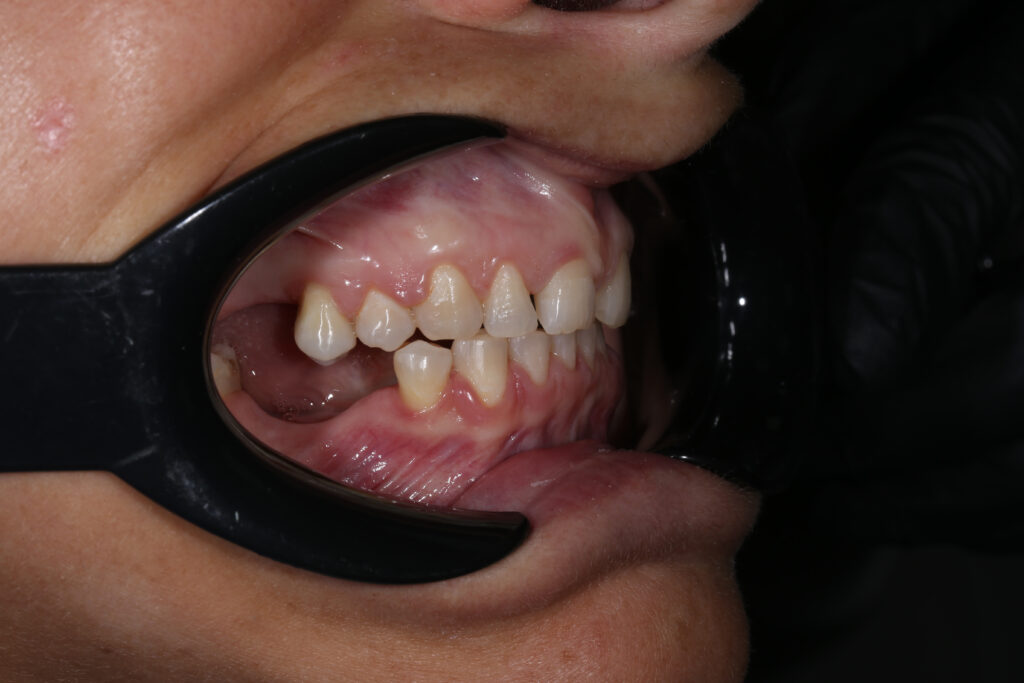 Результат лечения брекет-системой