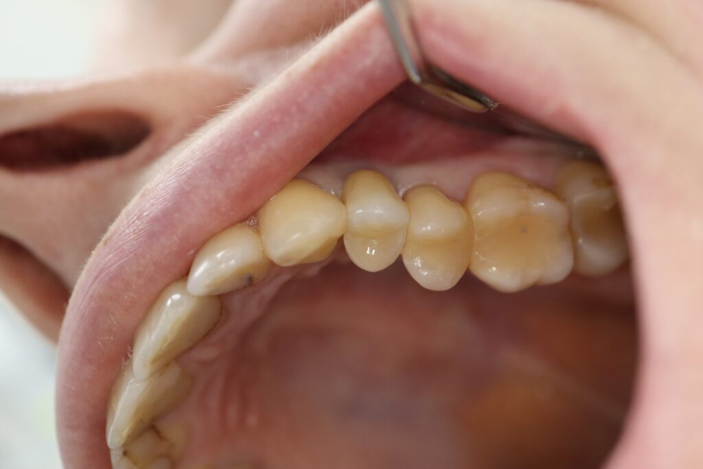 результат протезирования