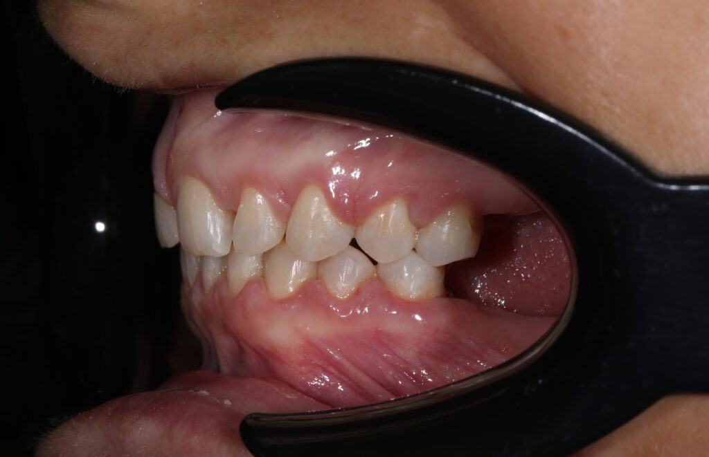 Результат лечения брекет-системой