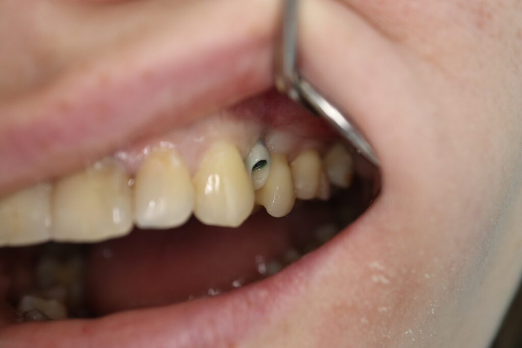 изготовление протеза