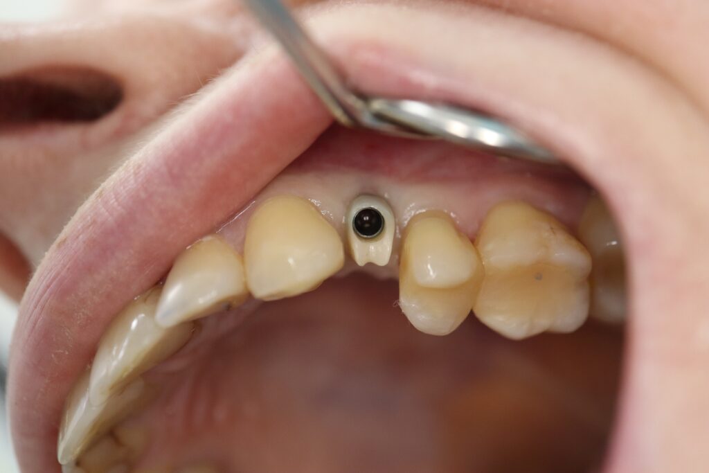 изготовление протеза