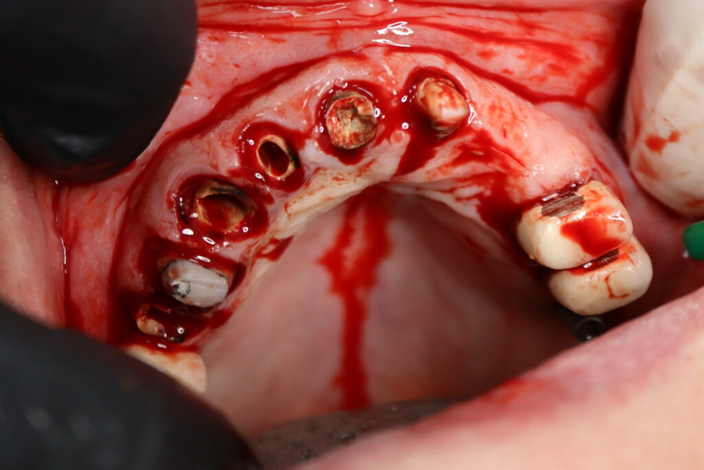 процесс имплантации