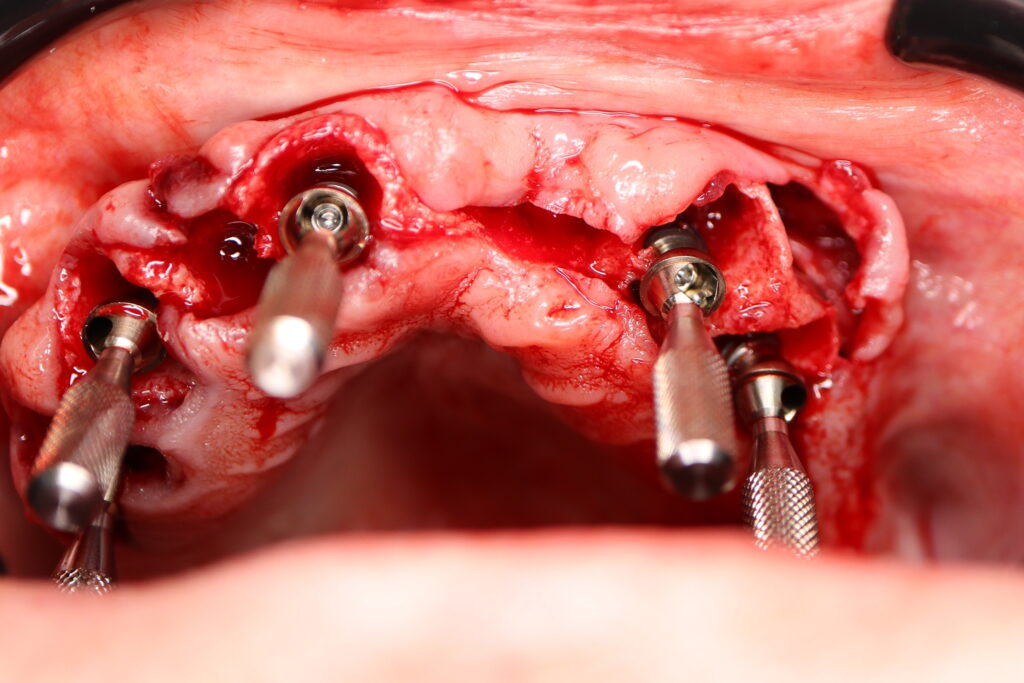 процесс тотальной имплантации
