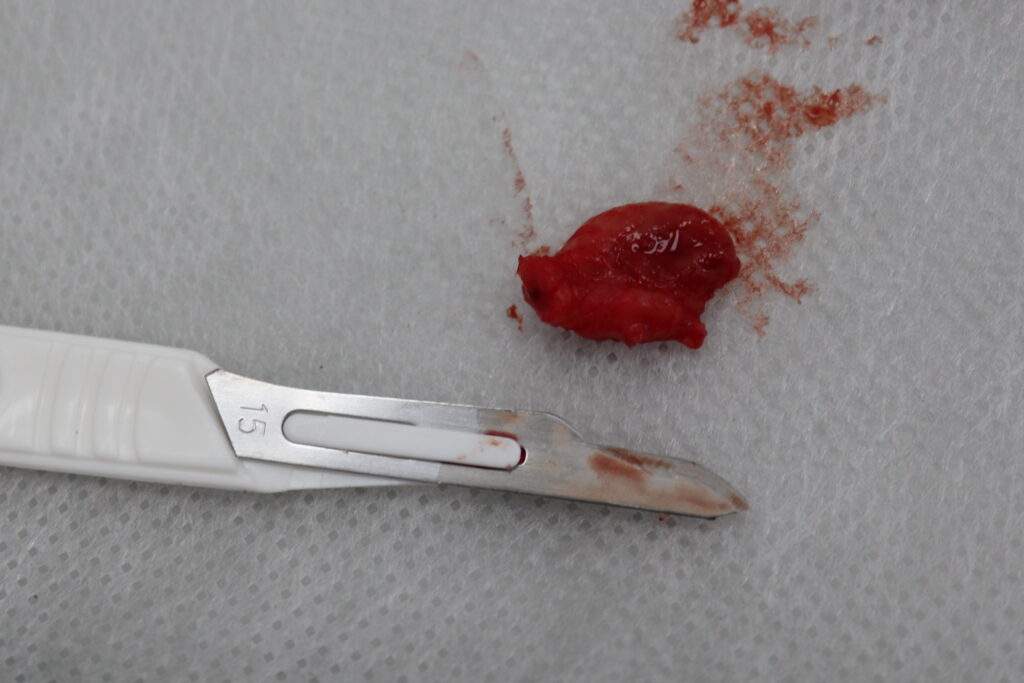 процесс тотальной имплантации