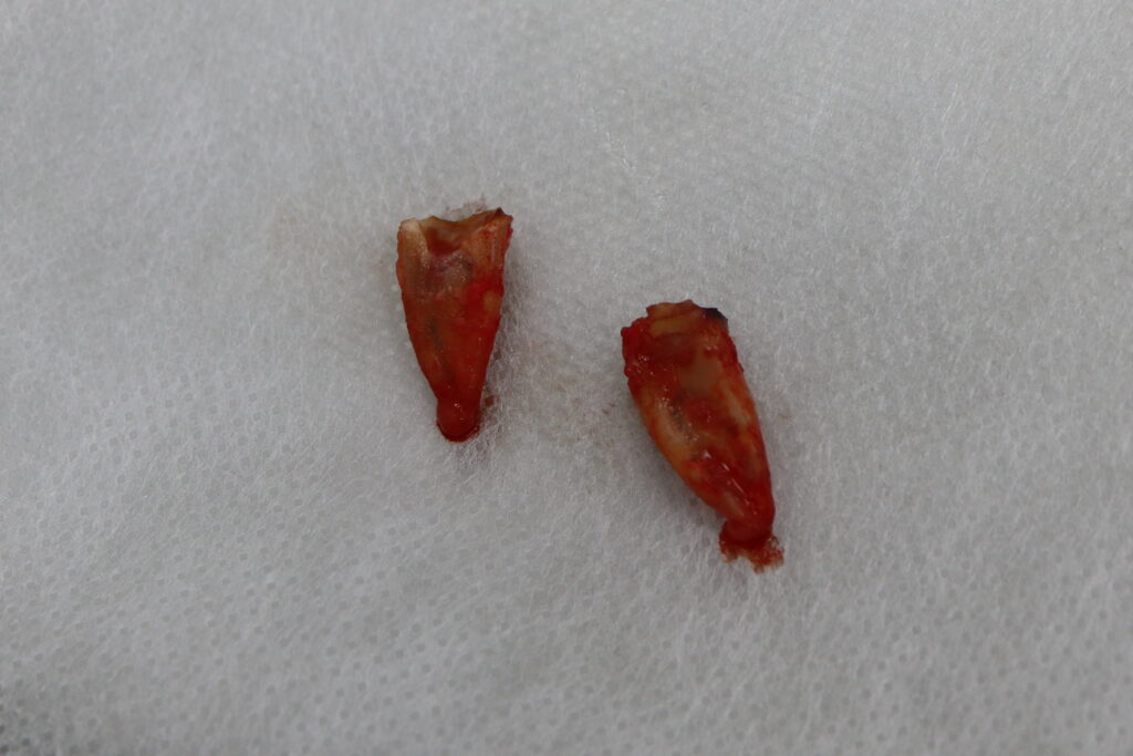 процедура имплантации