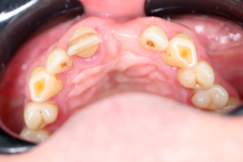 пациент до имплантации