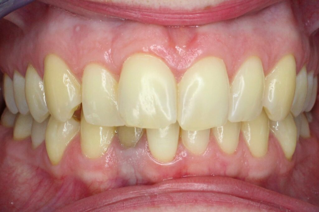 пациент до брекет-системы