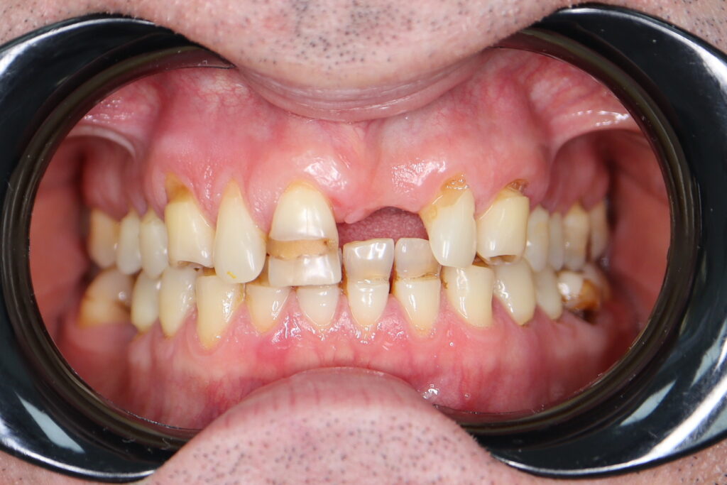 пациент до имплантации