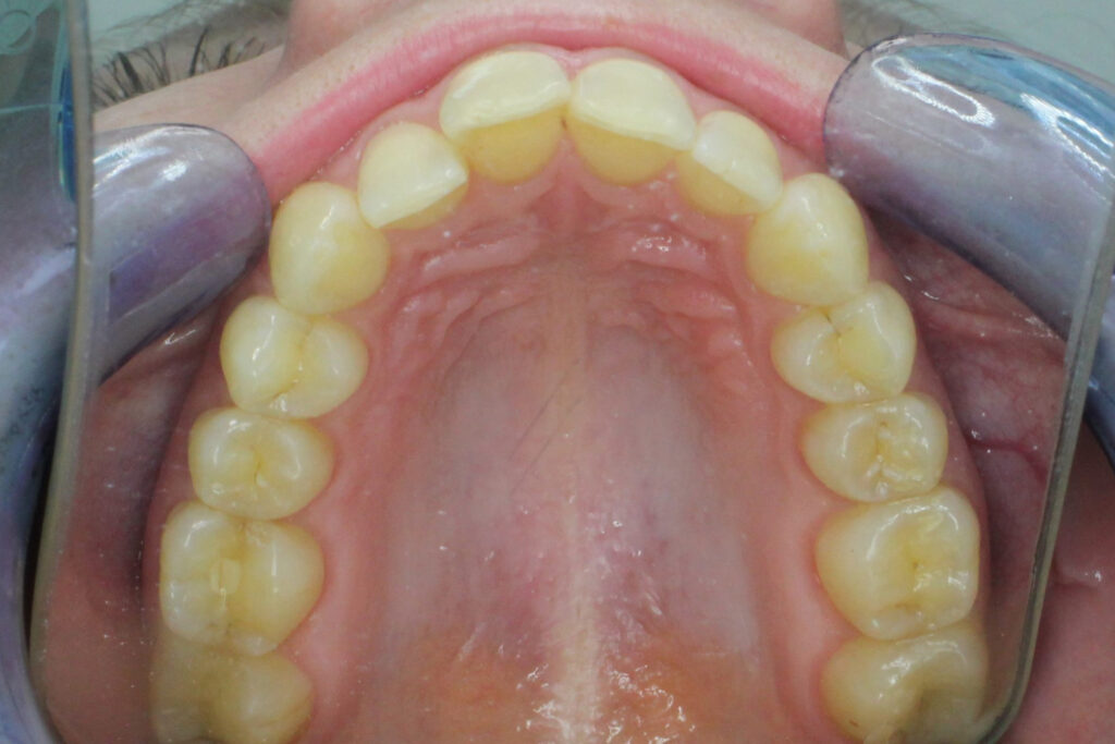 пациент до брекет-системы