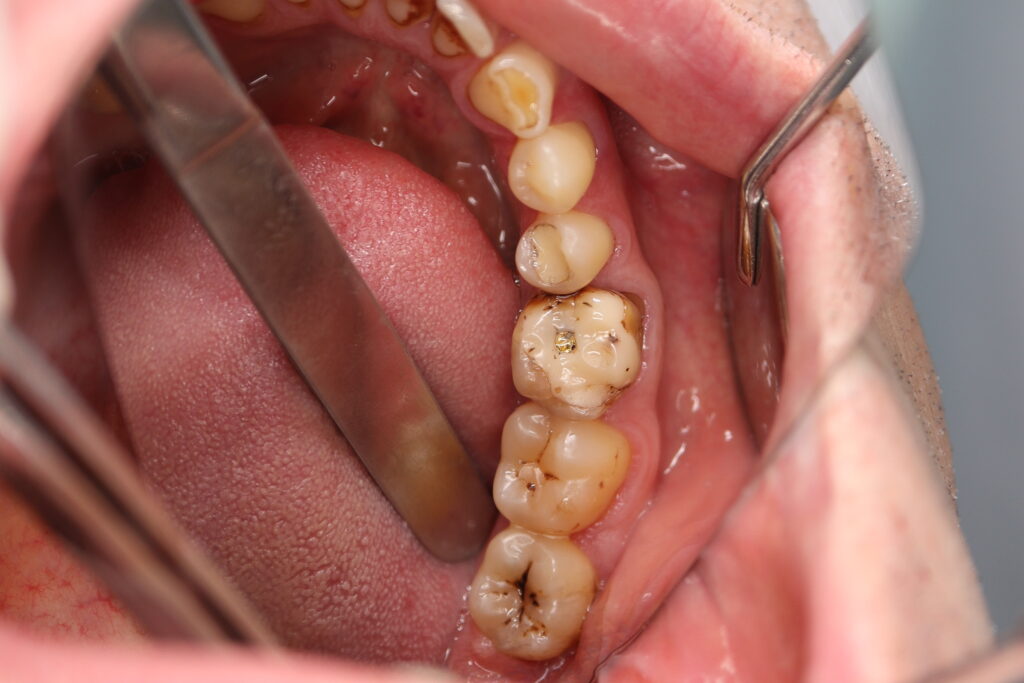 пациент до имплантации