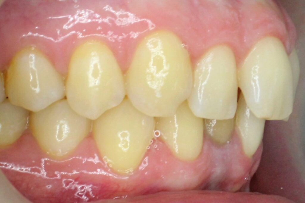 пациент до брекет-системы