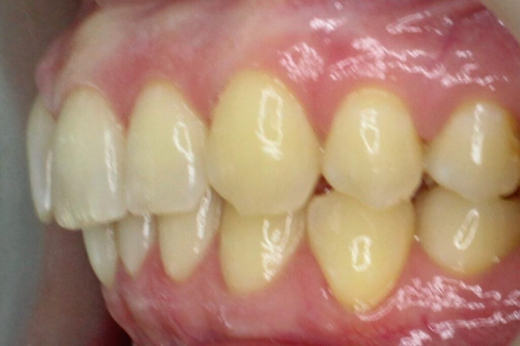 пациент до брекет-системы