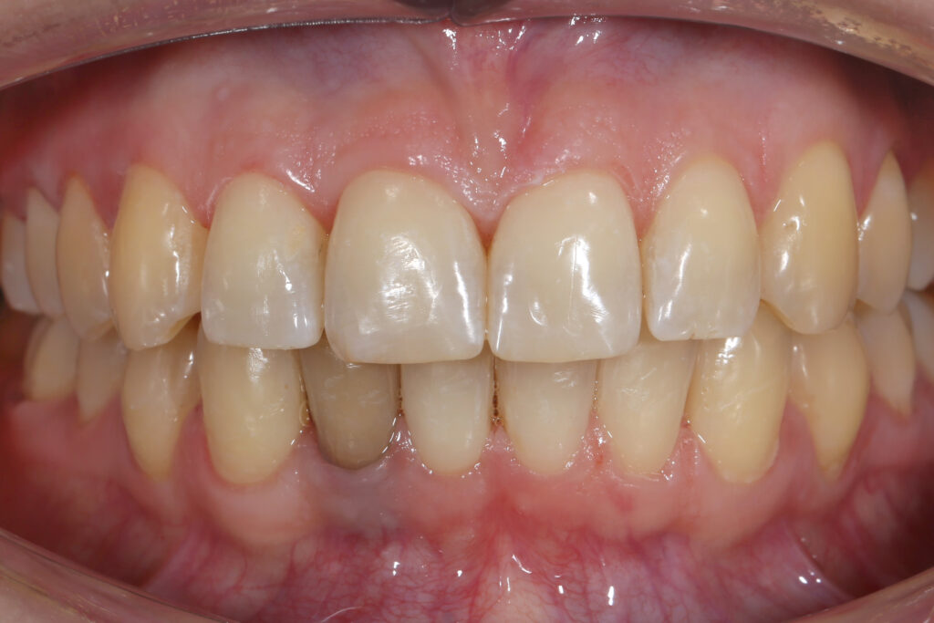 пациент после лечения брекет-системой