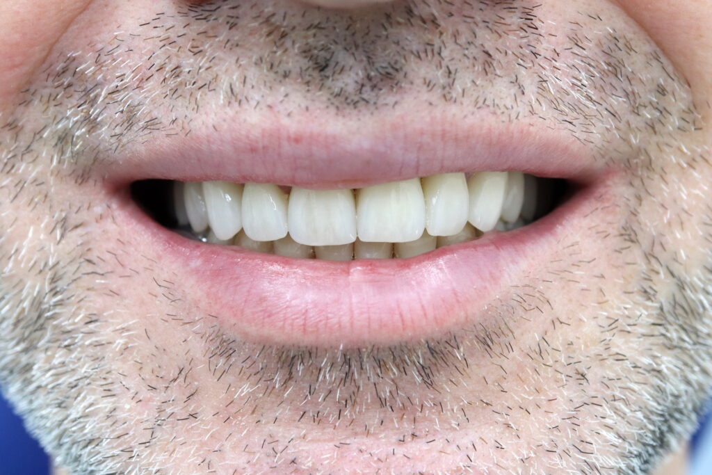 Имплантация Straumann BLT и комплексное протезирование