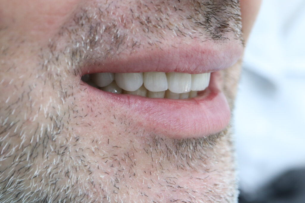 результат протезирования