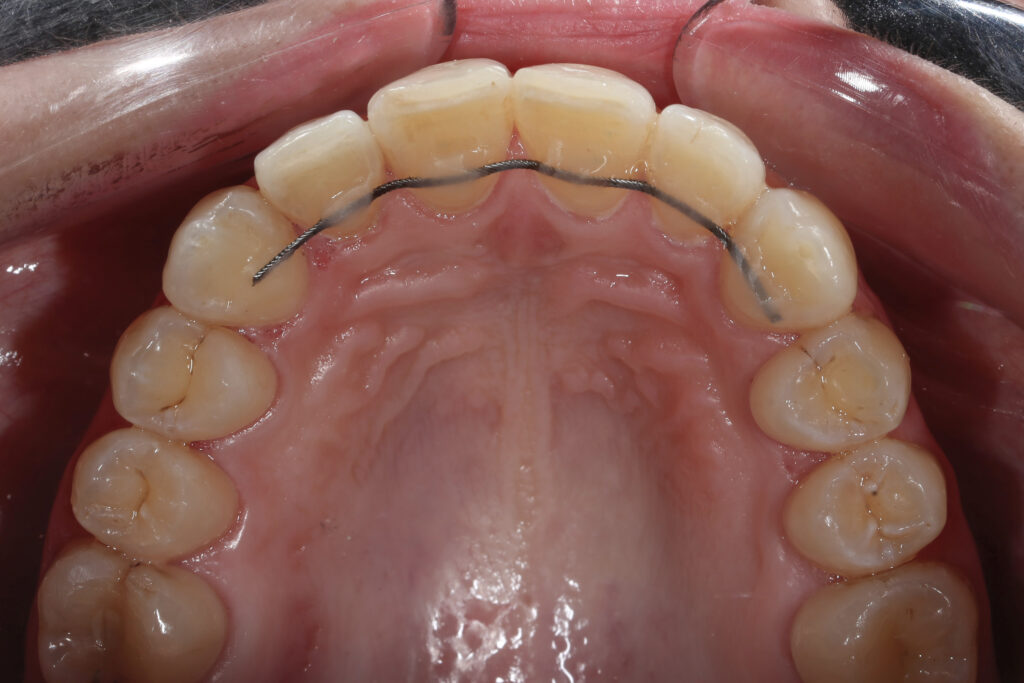 пациент после лечения брекет-системой