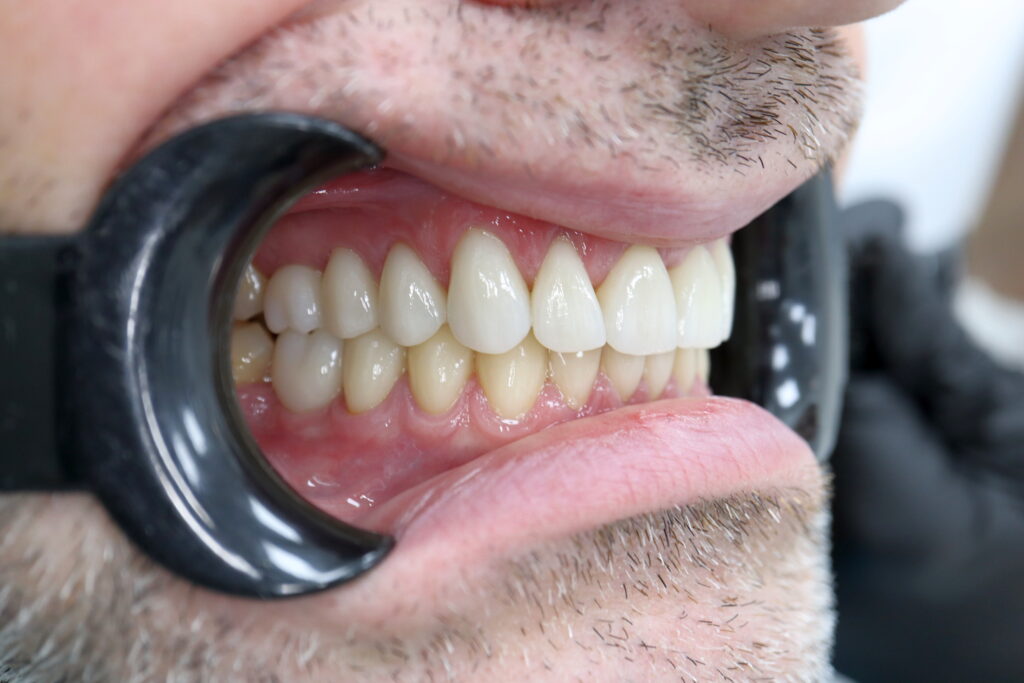 результат протезирования