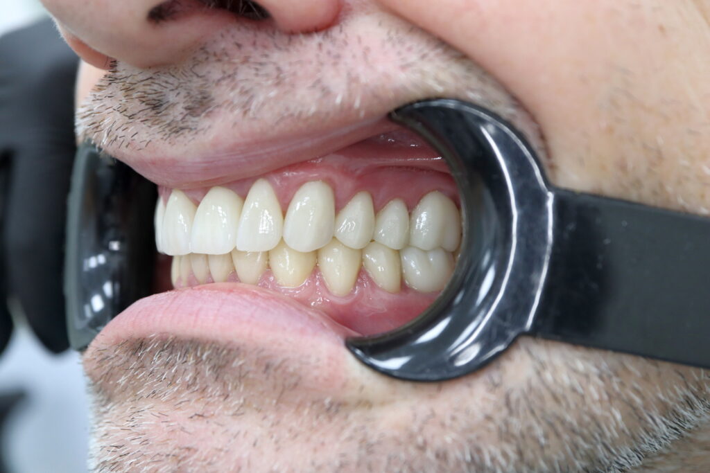 результат протезирования