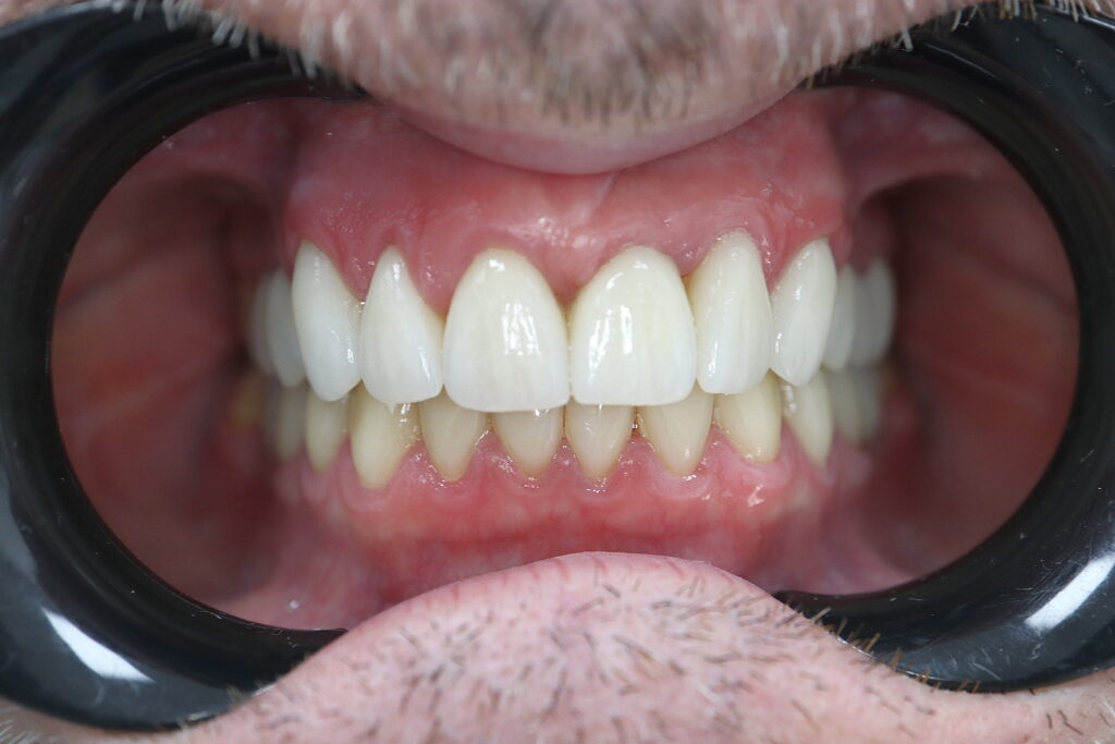 результат протезирования