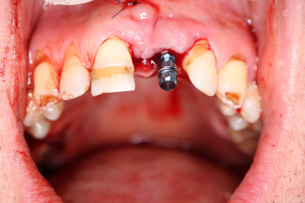 хирургический этап