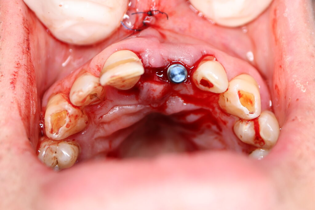 хирургический этап