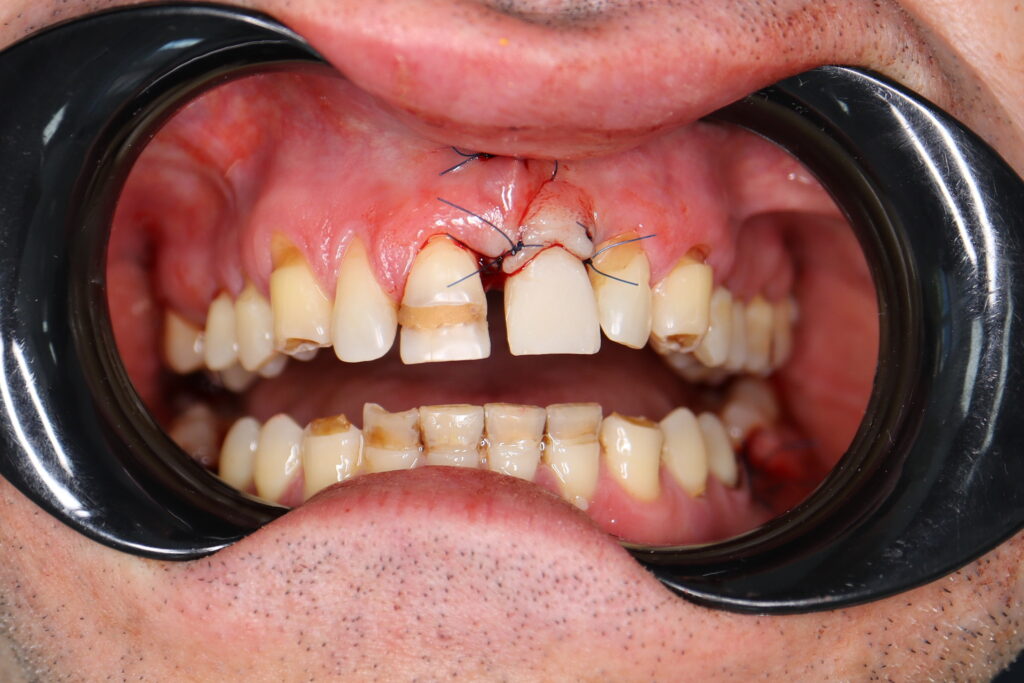 Результаты хирургического этапа