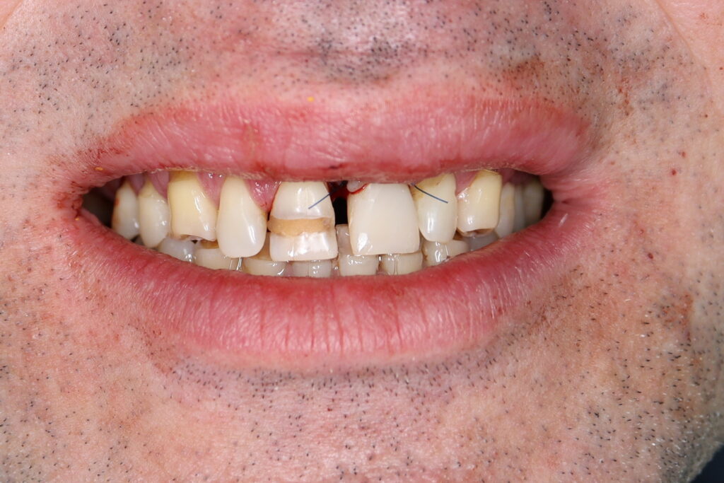 Результаты хирургического этапа