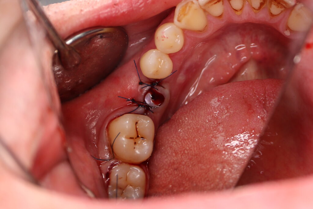 Результаты хирургического этапа