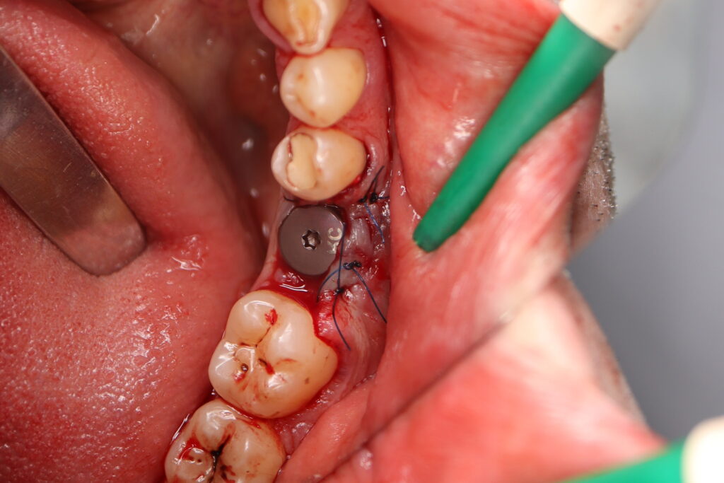 Результаты хирургического этапа